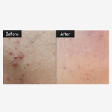 Reedle Shot 100 + Reedle Shot 300 (1ml x 3ea)